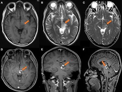 Transient partial regression of intracranial germ cell tumor in adult thalamus: A case report